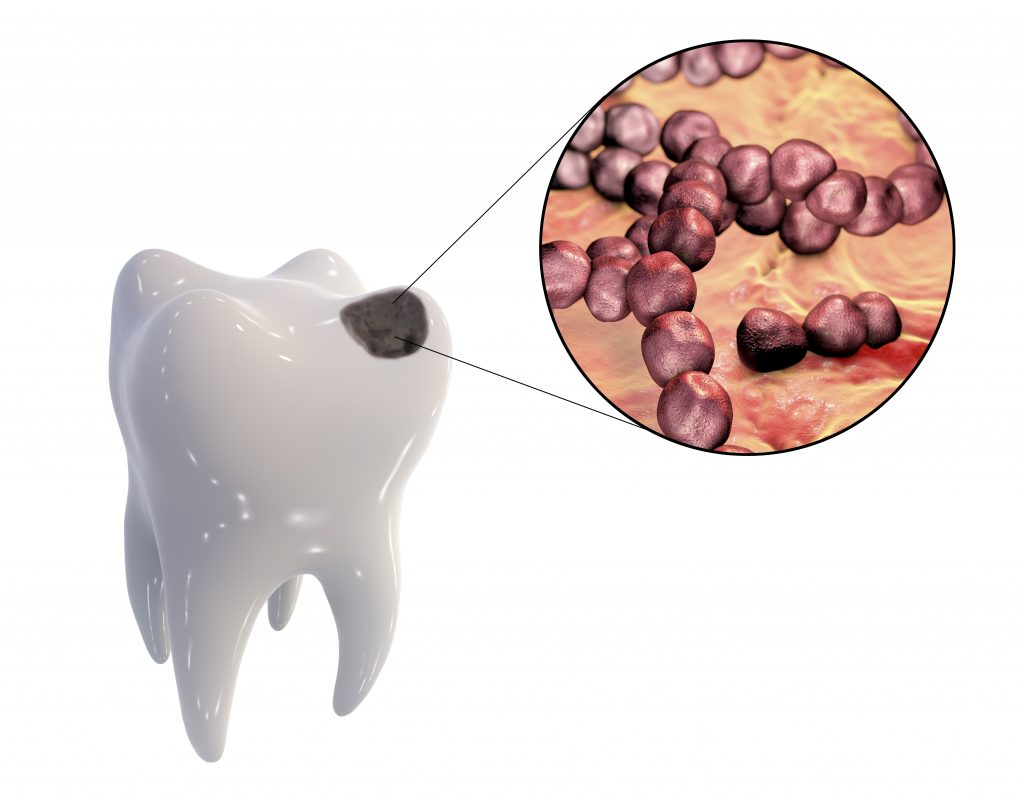 むし歯の中に住むミュータンスレンサ球菌