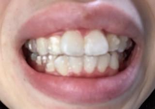 正面の歯
