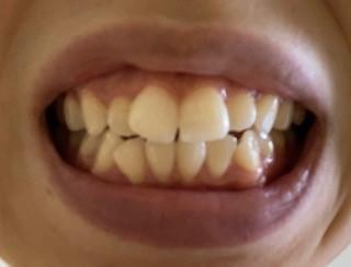 正面からの歯の写真